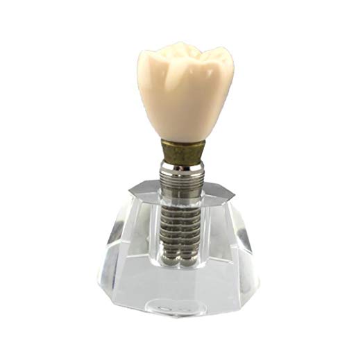 BZZBZZ Dental Implant Model - Detachable Human Teeth Model Resin Material for Medical Educational Training Aid and Dentist to Communicate with Patients